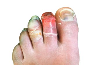 Human_toes,_12_days_post-frostbite